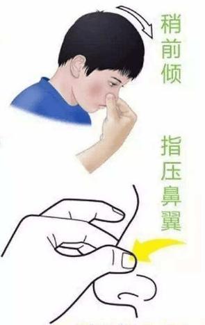 怎么才能让鼻血停止不流截图2