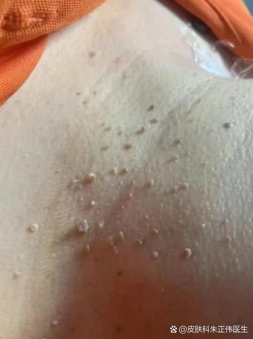 hpv感染症状