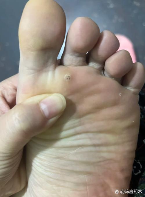 脚掌长病毒疣