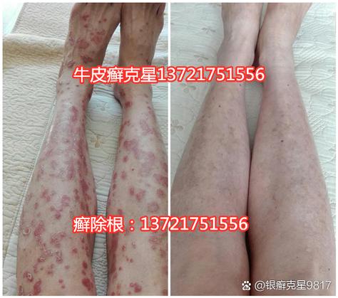 皮清爽治不治银屑病