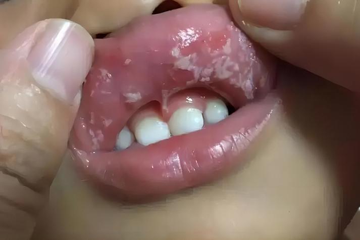 鹅口疮症状图片大全