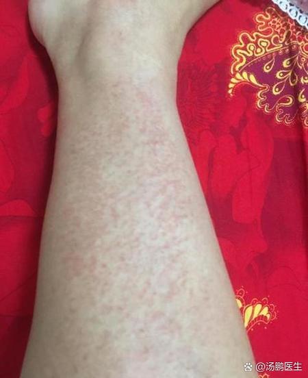 身上长了好多红色的小点是怎么回事