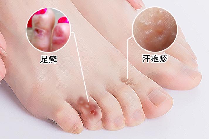 脚感染真菌的图片