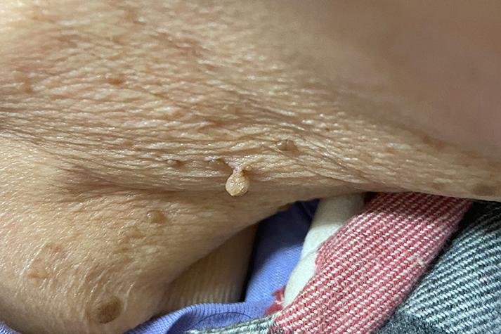 嘎鸡窝长个小肉揪是什么
