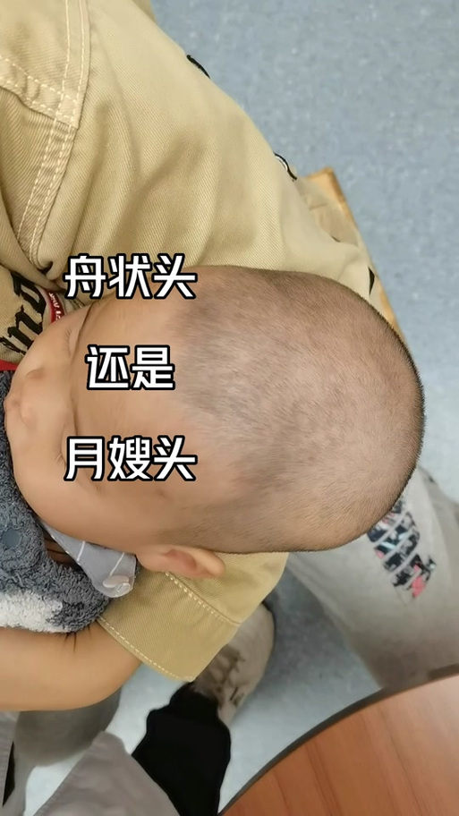 宝宝10个月头型还能矫正吗