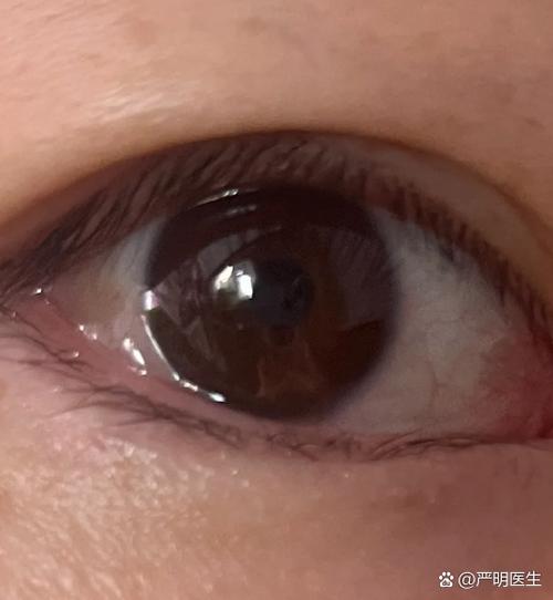 眼睛起了雾