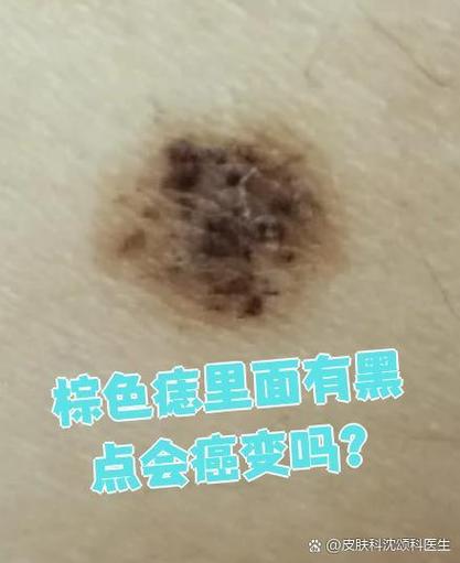 脸上长棕色的点点像痣