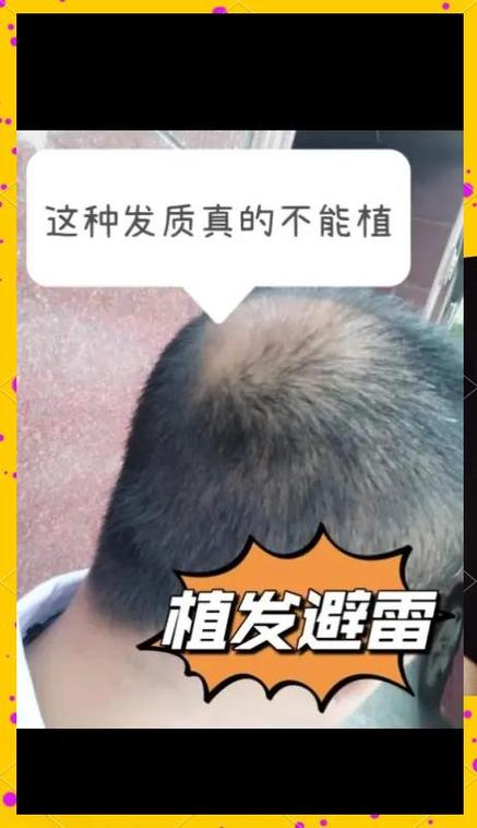 为什么不建议植发
