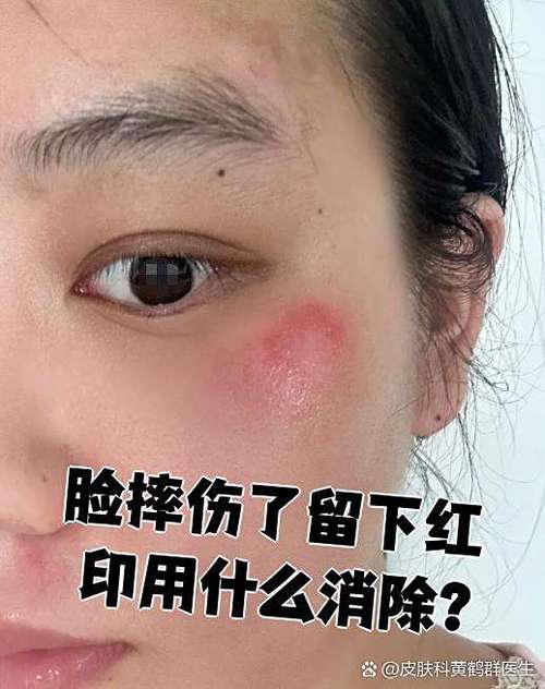 脸上蹭破皮后的红印怎么去掉