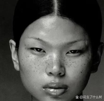 去雀斑