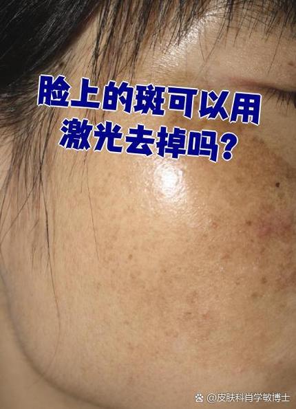 黑斑去除