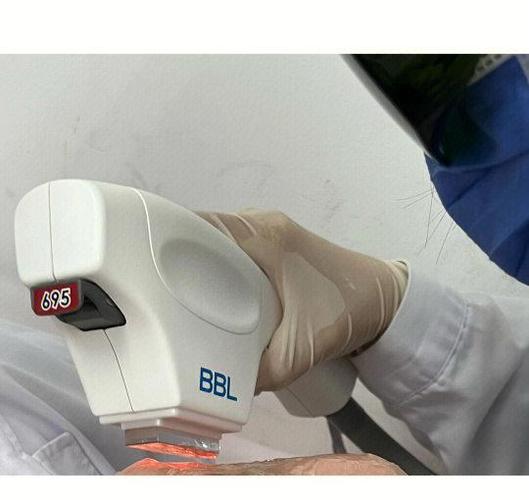bbl是什么医美项目