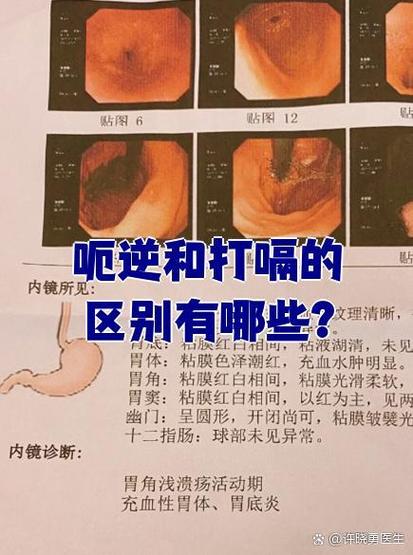 呃逆和打嗝的区别