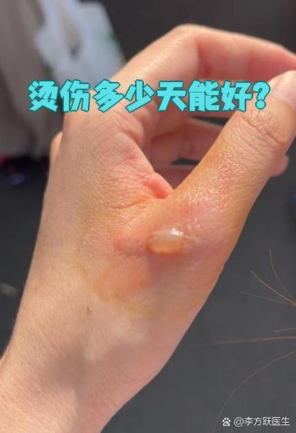 开水烫伤皮肤发红多久才能好