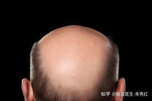 秃顶了还能长出头发吗
