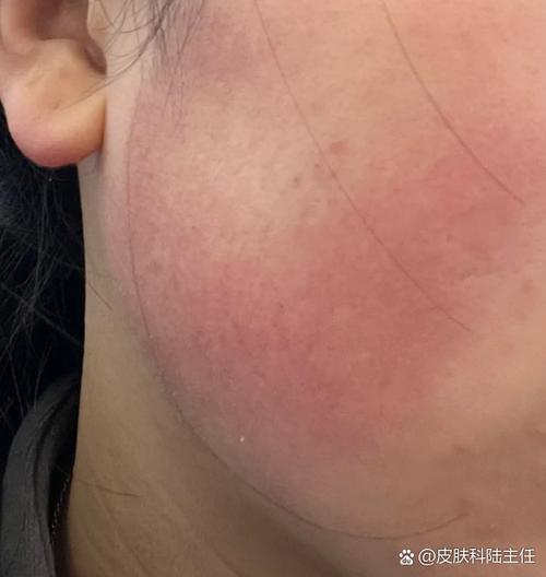 脸上一块红红的像癣