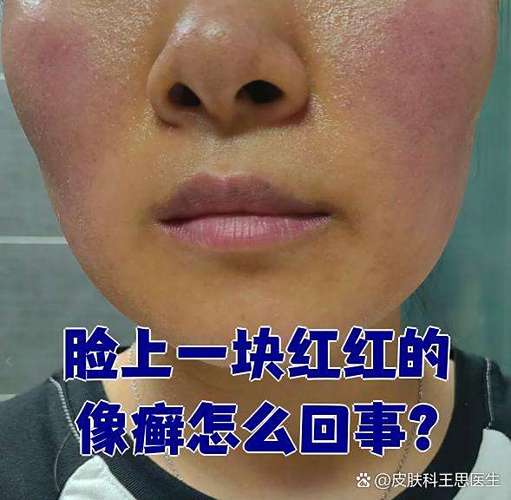 脸上一块红红的像癣截图2