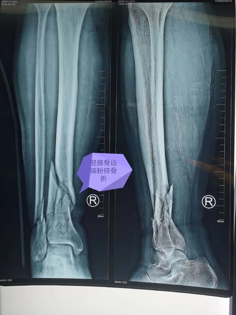 什么叫胫腓骨远端骨折