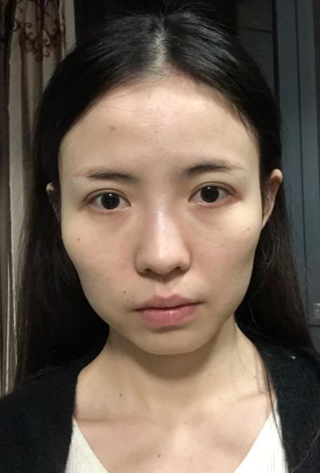 脸颊凹陷怎么恢复饱满