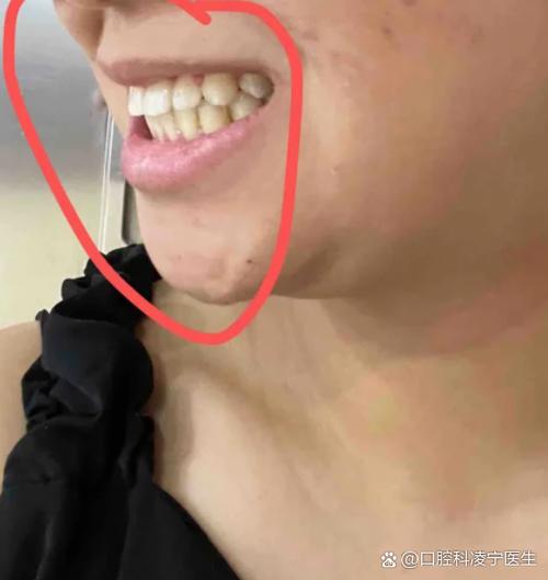 儿童上下牙咬合错位图片