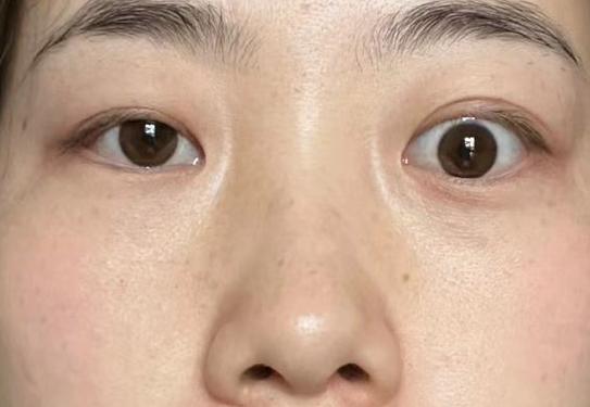 面部剧烈抖动