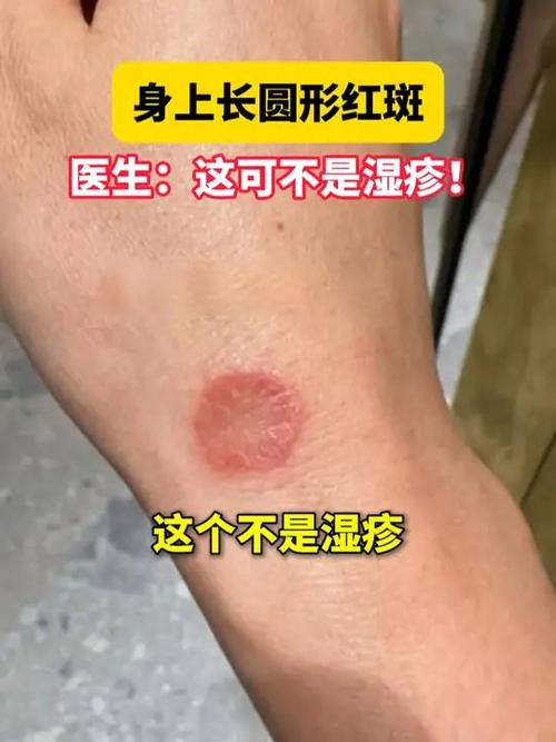 皮肤出现圆形红斑