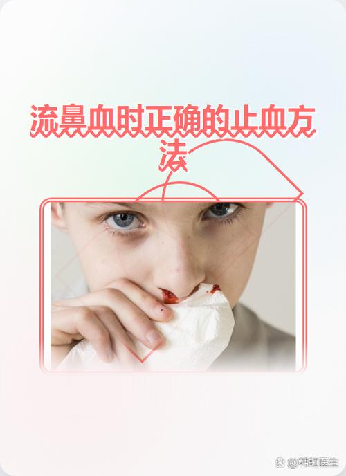 流鼻血怎么快速止血