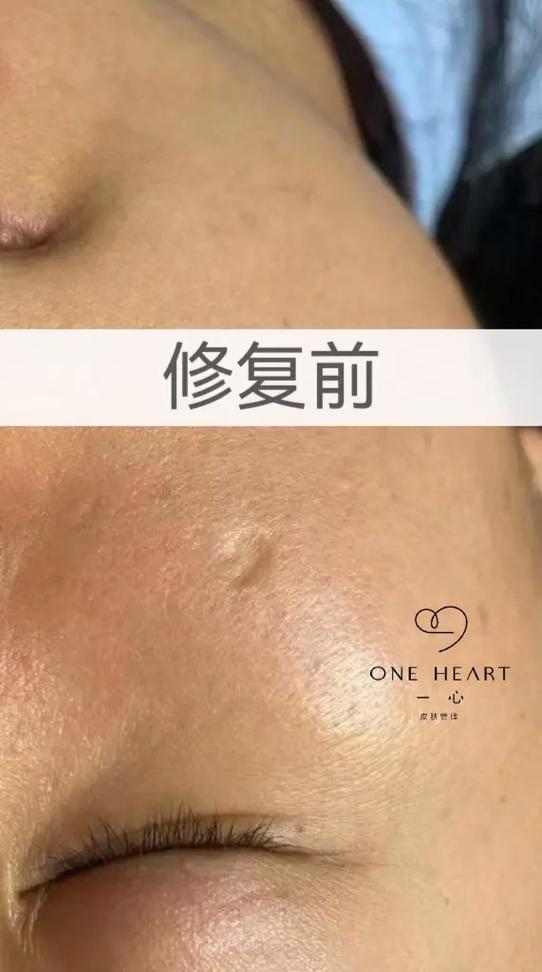 脸上痘坑很多年有办法修复吗