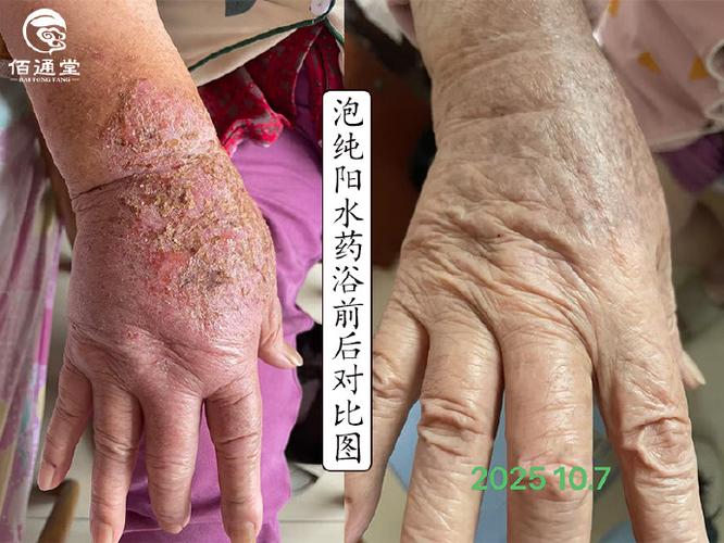 80岁老人湿疹要警惕