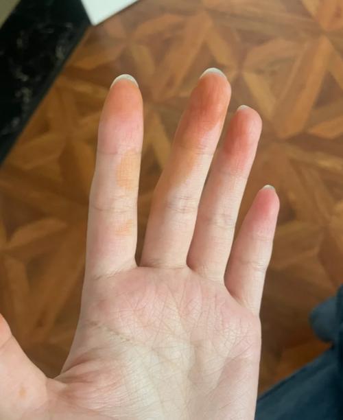 睡一觉起来手指变黄了