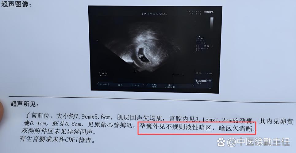 子宫液性暗区怀孕几率