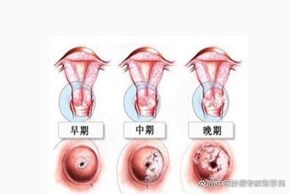 寡转移治愈率有多高