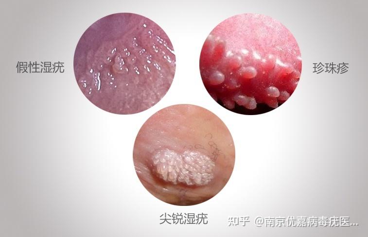 病毒疣和尖锐的区别