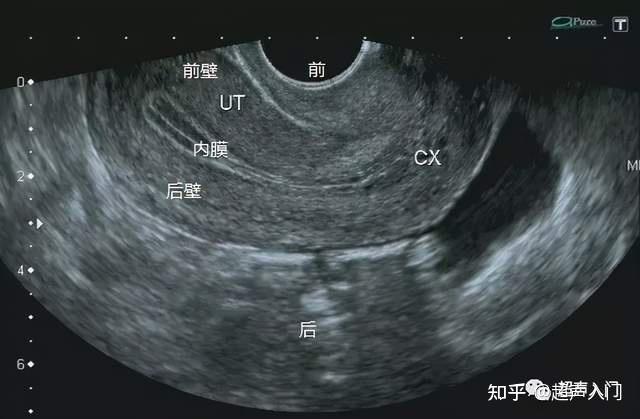 阴超子宫前后位的区别