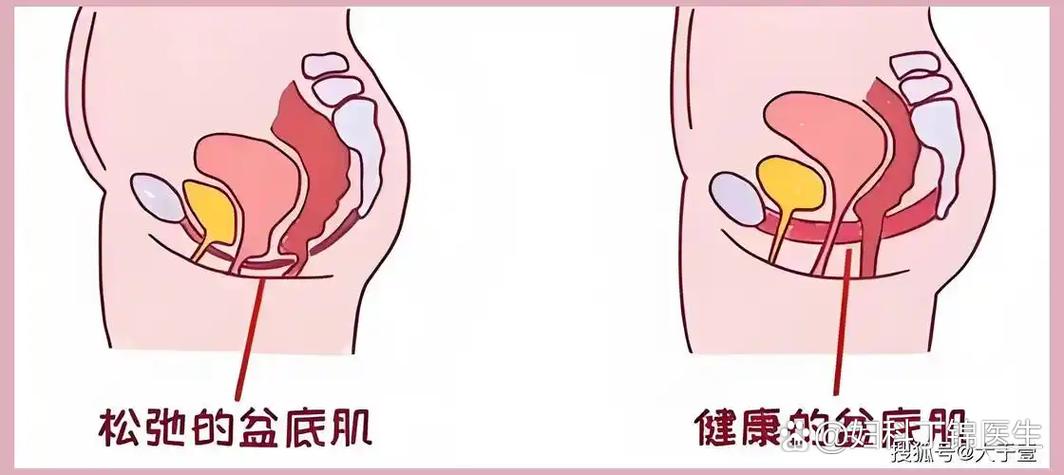 盆底肌修复会变紧致吗