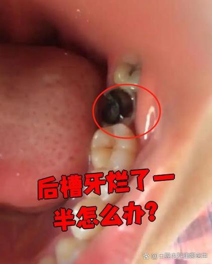 蛀牙怎么办