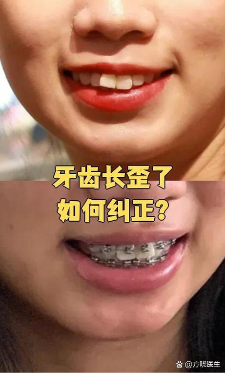 牙齿有一点歪需要矫正吗
