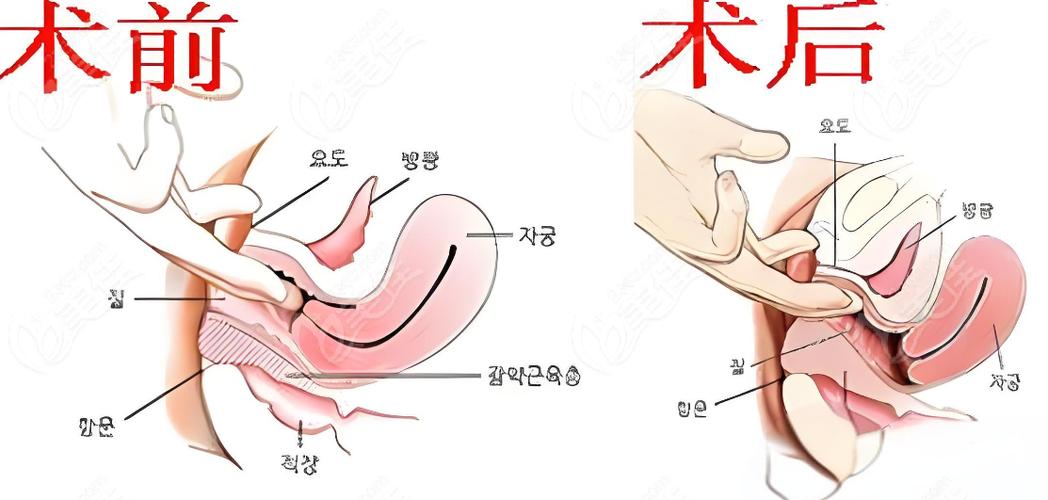 做紧缩手术在哪里做截图2