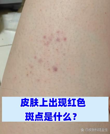 肤色偏红是什么体质截图2