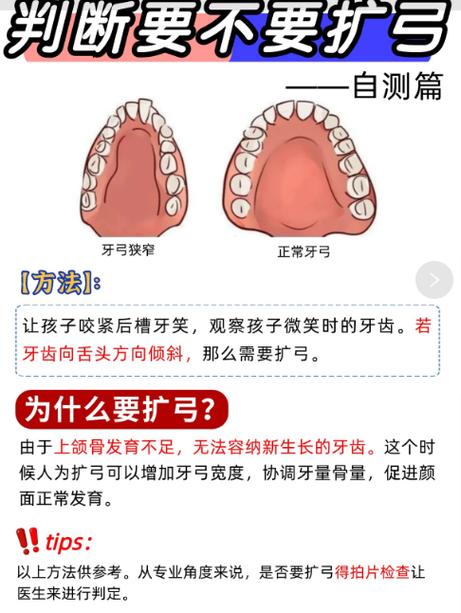 牙弓狭窄矫正的最佳年龄