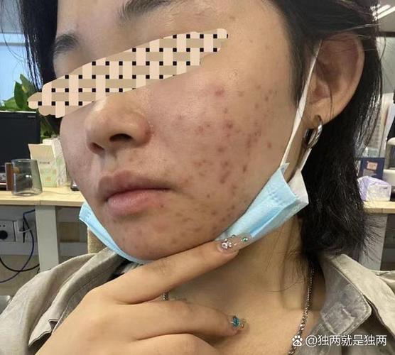 痘印一般多久会消失