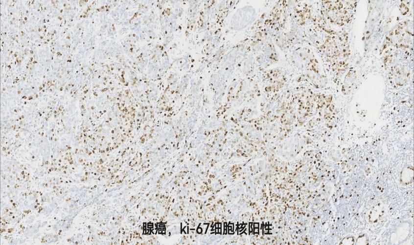 E–cadherin阳性好吗