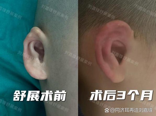 小耳畸形手术大概要多少钱