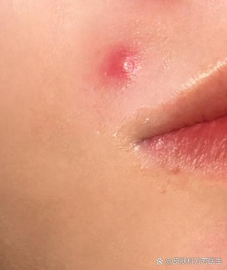 脸上痘痘红肿硬块