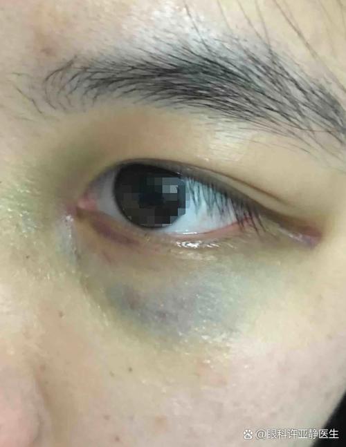 眼睛淤青消除的小偏方