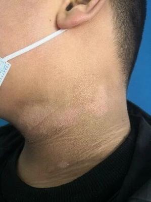 肥胖引起的黑棘皮病怎么治疗
