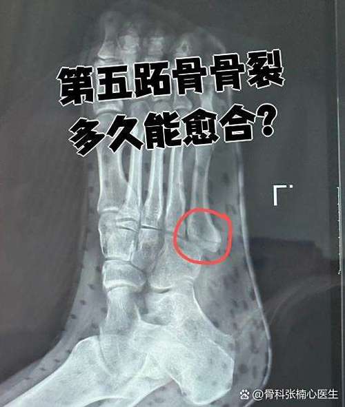 骨头有裂缝多久能好