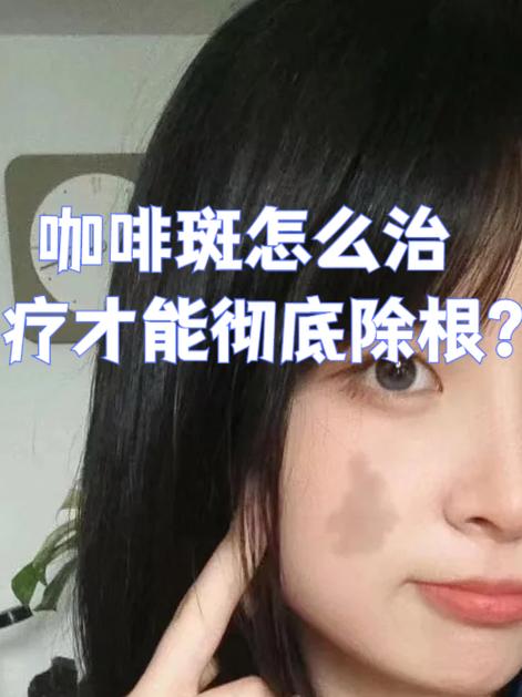 咖啡斑可以根治吗 咖啡斑可以根治吗