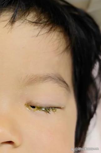 眼睛眼屎多又粘又模糊