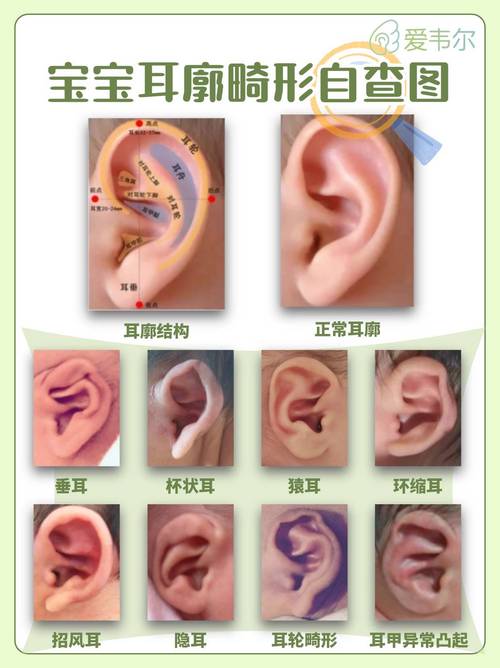 新生儿耳廓畸形是什么引起的图标